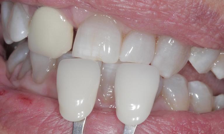 After Kor Tooth Whitening | Cook Family & Cosmetic Dentistry | Birmingham, AL