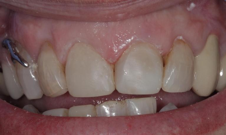 Whitened and repaired teeth with veneers | Cook Family & Cosmetic Dentistry | Birmingham, AL