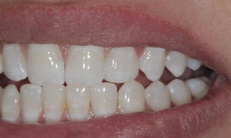 Cosmetic bonding to close gaps | Cook Family & Cosmetic Dentistry | Birmingham, AL