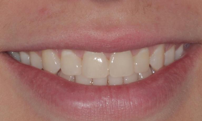 ClearCorrect after | Cook Family & Cosmetic Dentistry | Birmingham, AL