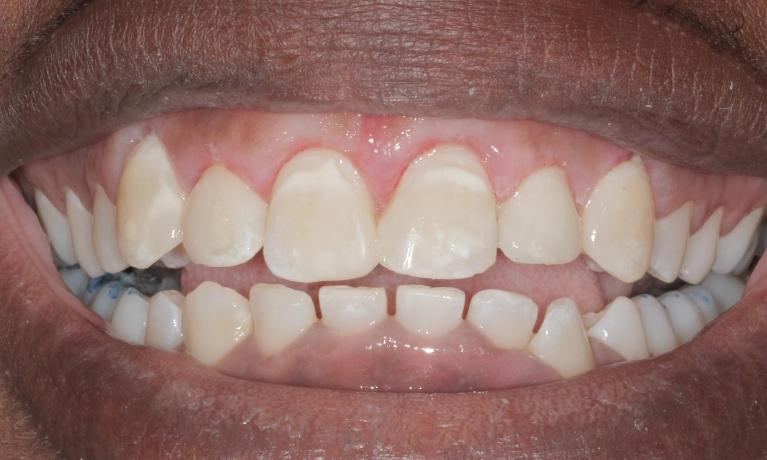 Re-Shaped gums with lasers | Cook Family & Cosmetic Dentistry | Birmingham, AL