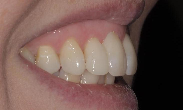 Straightened, brightened teeth | Cook Family & Cosmetic Dentistry | Birmingham, AL