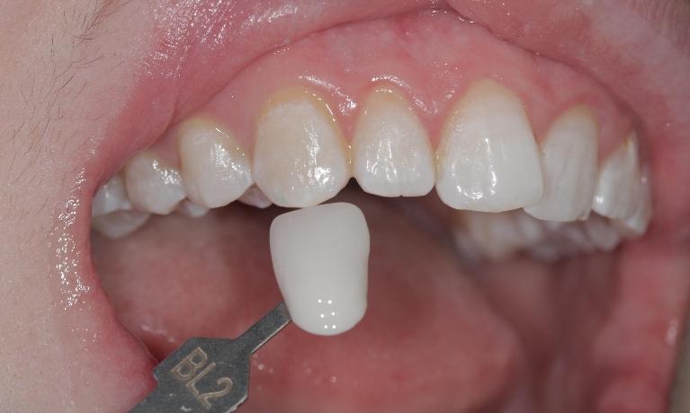 After Whitening | Cook Family & Cosmetic Dentistry | Birmingham, AL