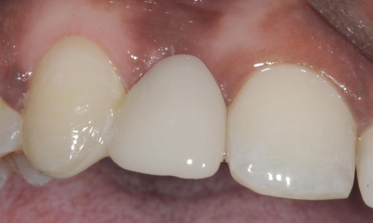 Maryland Bridge After | Cook Family & Cosmetic Dentistry | Birmingham, AL