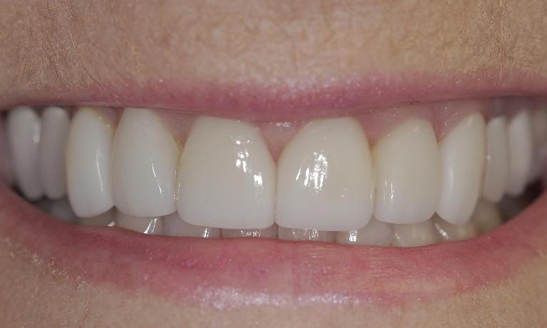 Veneers | Cook Family & Cosmetic Dentistry | Birmingham, AL