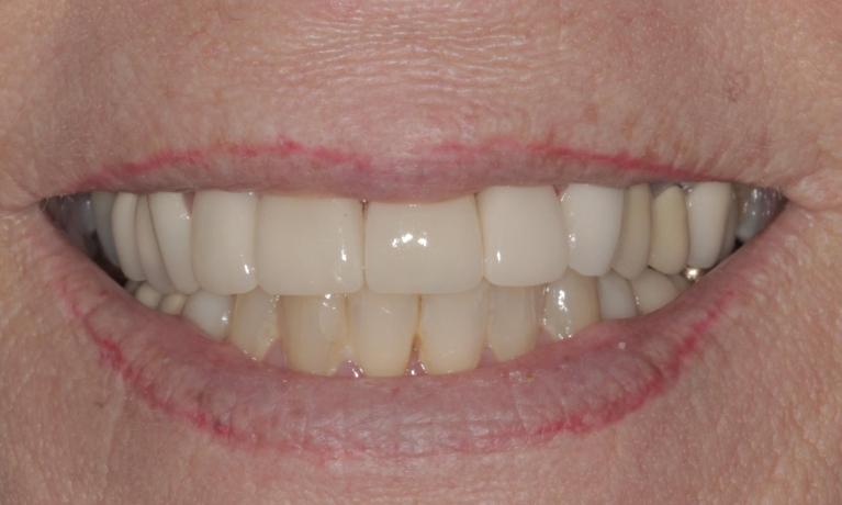 Porcelain Veneers after | Cook Family & Cosmetic Dentistry | Birmingham, AL