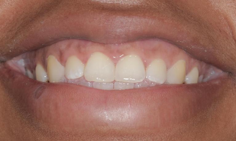 Space closed with cosmetic bonding | Cook Family & Cosmetic Dentistry | Birmingham, AL