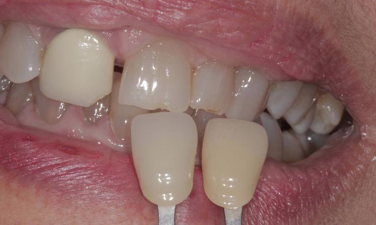 before tooth whitening | Cook Family & Cosmetic Dentistry | Birmingham, AL