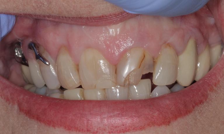 cracked and stained teeth before | Cook Family & Cosmetic Dentistry | Birmingham, AL