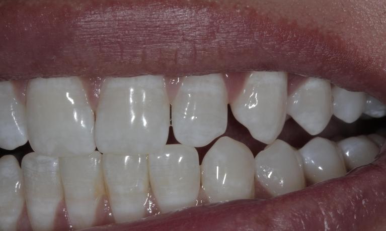 Gaps in teeth on side | Cook Family & Cosmetic Dentistry | Birmingham, AL