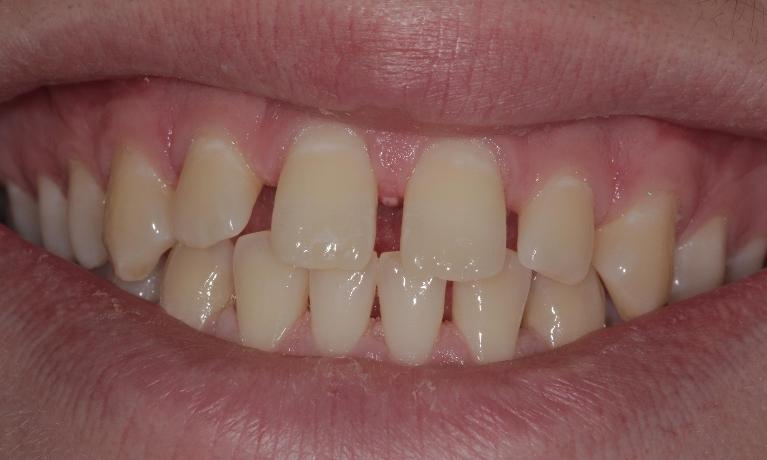 Teeth with gaps before | Cook Family & Cosmetic Dentistry | Birmingham, AL