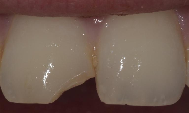 Chipped tooth | Cook Family & Cosmetic Dentistry | Birmingham, AL