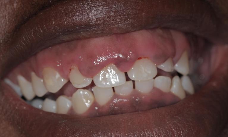 over-sized gums | Cook Family & Cosmetic Dentistry | Birmingham, AL