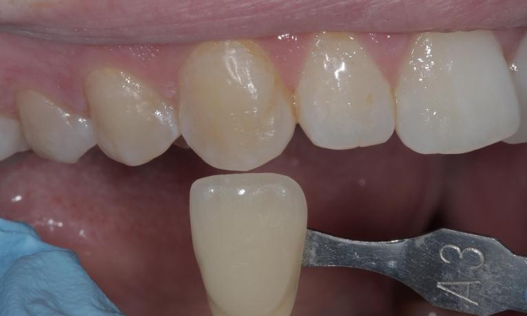 Stained, yellowed teeth | Cook Family & Cosmetic Dentistry | Birmingham, AL