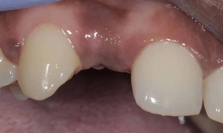 Missing Tooth before | Cook Family & Cosmetic Dentistry | Birmingham, AL