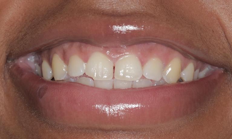gaps in front teeth | Cook Family & Cosmetic Dentistry | Birmingham, AL