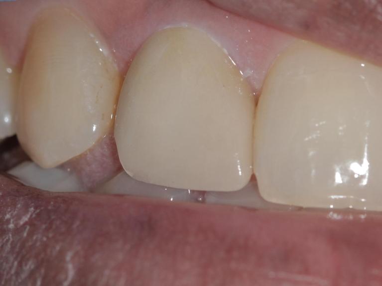 Replaced crown now | Cook Family & Cosmetic Dentistry | Birmingham, AL