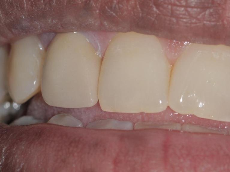Replaced porcelain crown | Cook Family & Cosmetic Dentistry | Birmingham, AL