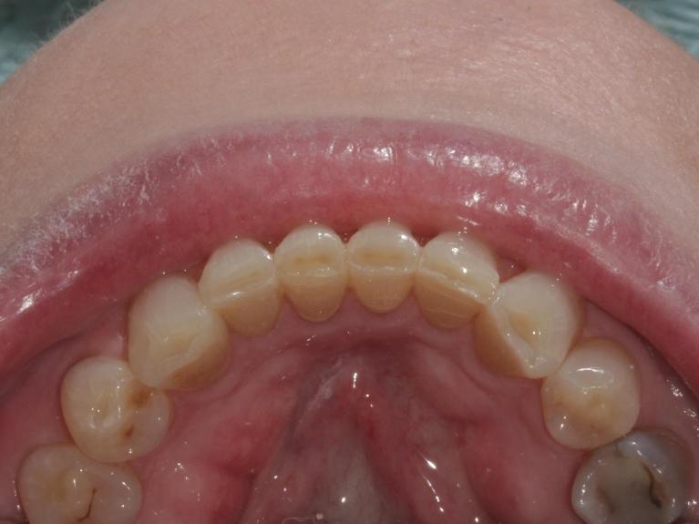 straightened, aligned teeth | Cook Family & Cosmetic Dentistry | Birmingham, AL