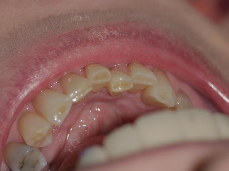 Crooked misplaced teeth | Cook Family & Cosmetic Dentistry | Birmingham, AL