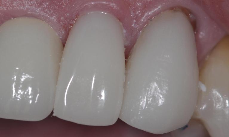 Repaired broken crown | Cook Family & Cosmetic Dentistry | Birmingham, AL