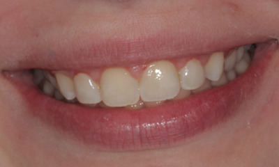 After treatment - Cosmetic bonding 