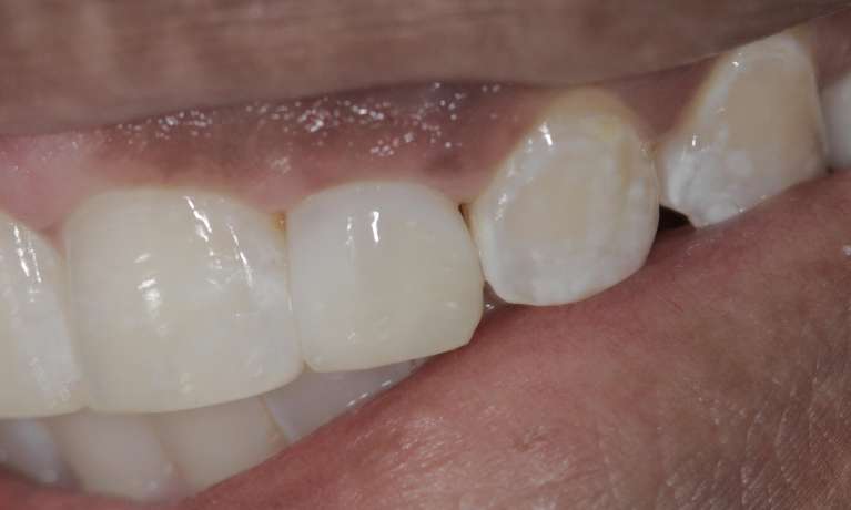 Resin-veneer-After-Image