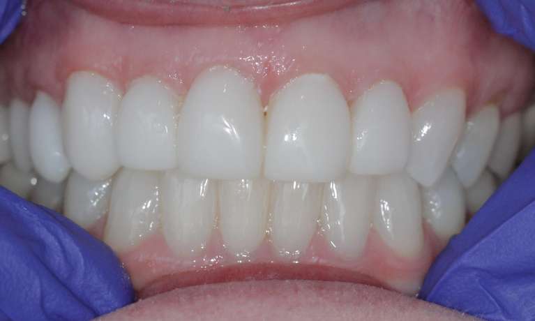 image of teeth after getting Resin veeners in Birmingham AL