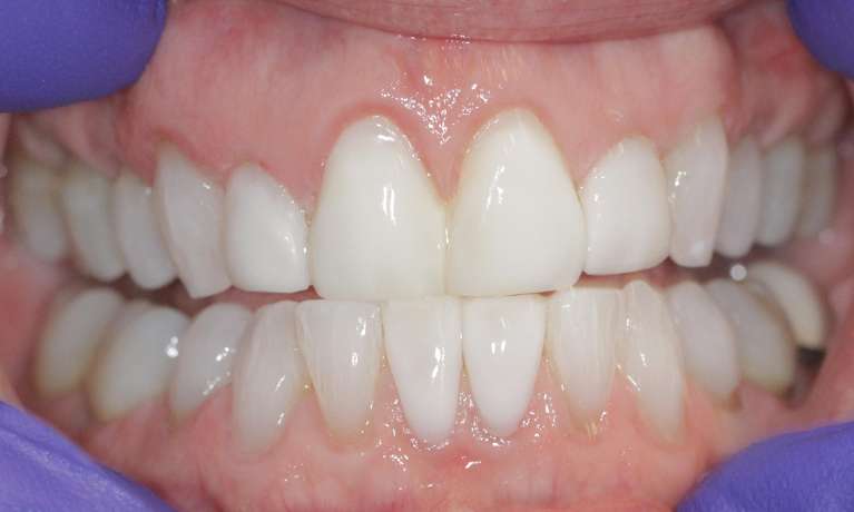 Resin-veneers-to-refresh-a-smile-After-Image