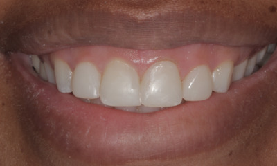After treatment - resin veneers 
