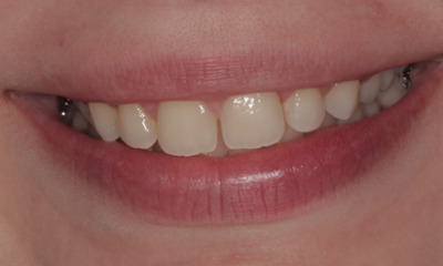 Before treatment - Cosmetic bonding 
