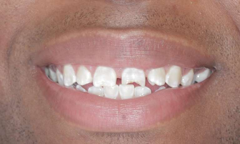 Laser-Resin-Veneers-Before-Image