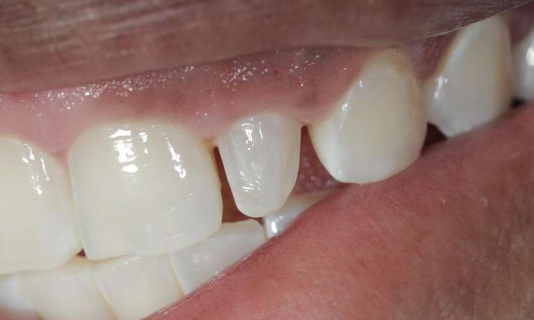 Resin-veneer-Before-Image