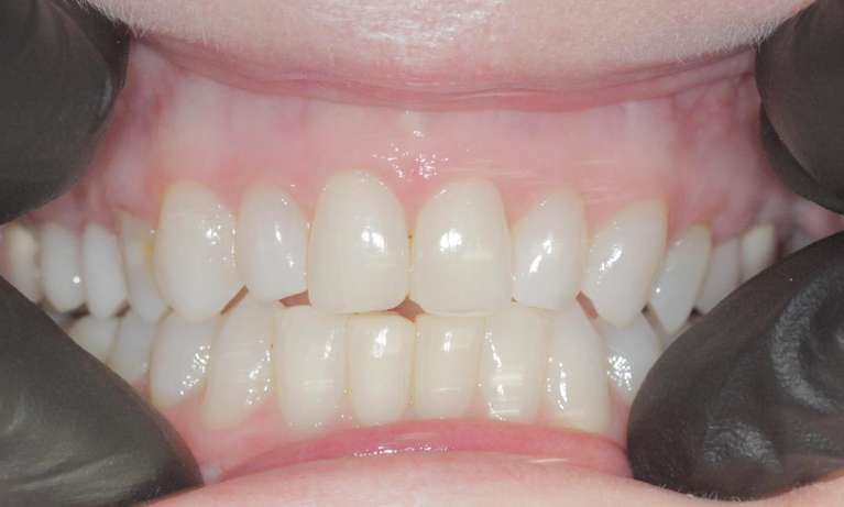 image of teeth before getting Resin veeners in Birmingham AL