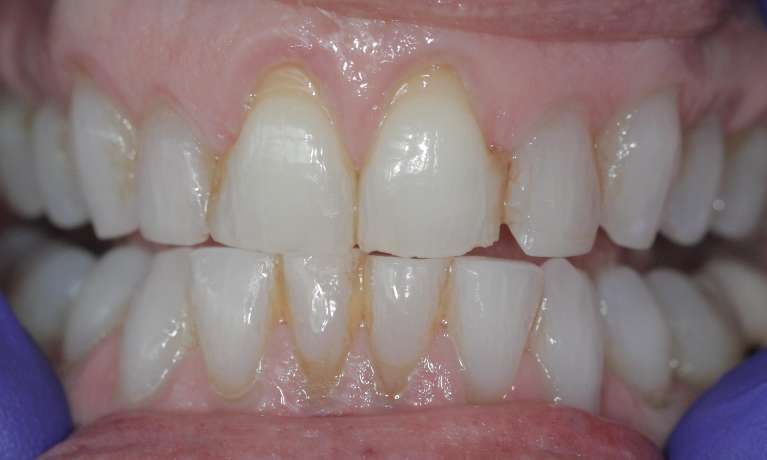 Resin-veneers-to-refresh-a-smile-Before-Image