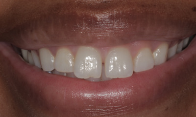 Before treatment - resin veneers 