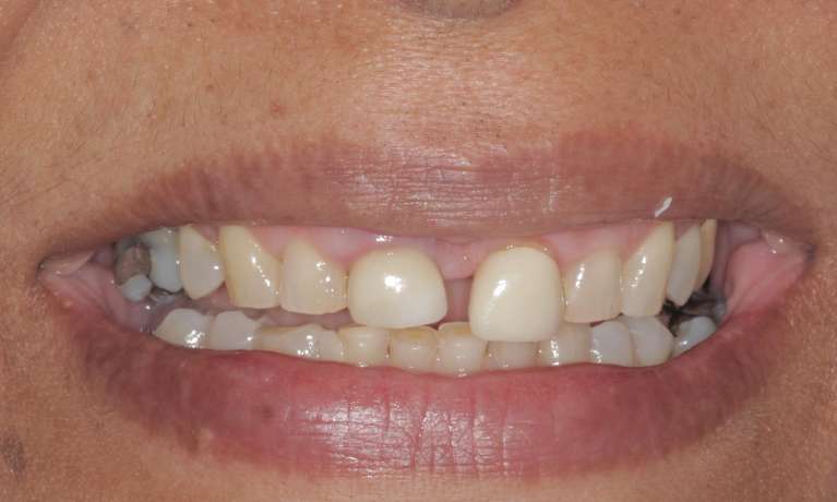Veneers-to-improve-a-smile-Before-Image