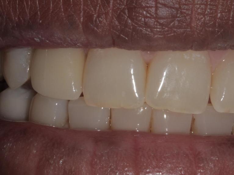 Cracked porcelain crown | Cook Family & Cosmetic Dentistry | Birmingham, AL