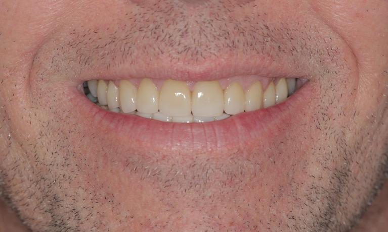 After crowns and veneers | Cook Family & Cosmetic Dentistry | Birmingham, AL