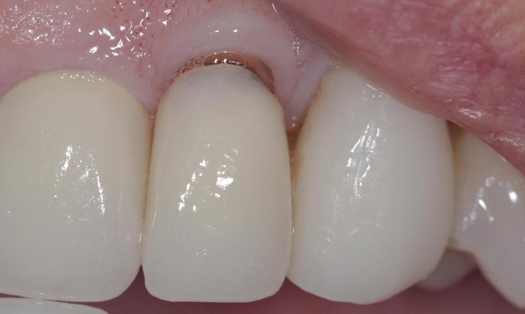 Old crown falling out | Cook Family & Cosmetic Dentistry | Birmingham, AL